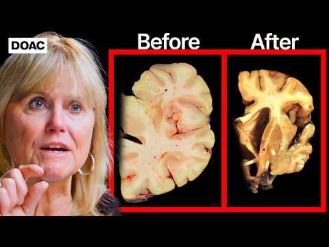 How to Prevent Alzheimer's and Dementia thumbnail
