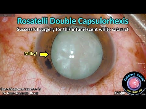 CataractCoach™ 2648: Rosatelli double capsulorhexis for white cataracts thumbnail
