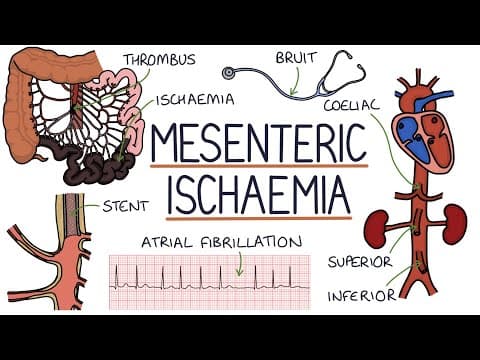 Understanding Mesenteric Ischaemia thumbnail