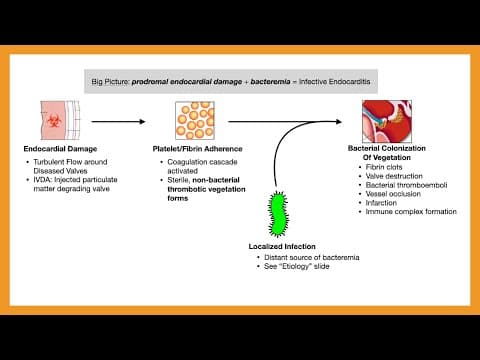 Infective Endocarditis thumbnail