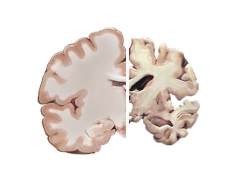 Alzheimer's and the Brain thumbnail
