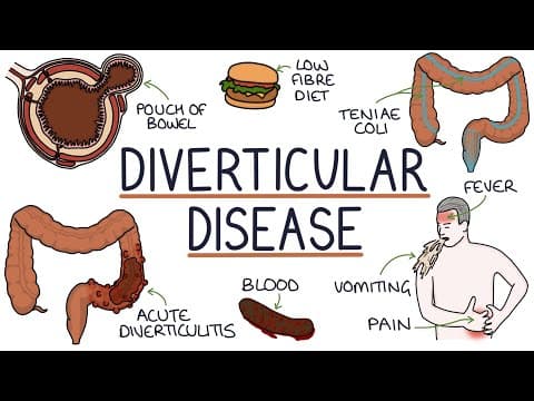 Understanding Diverticulosis and Diverticulitis thumbnail