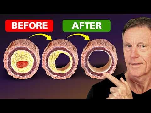 How to Reverse Plaque — 20 Years of Knowledge in One Video thumbnail