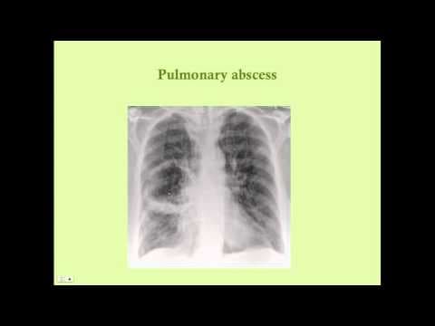 Pulmonary Infections - CRASH! Medical Review Series thumbnail
