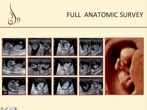 Tips and Tricks to Examining the Midsagittal View at 11-14 Weeks thumbnail