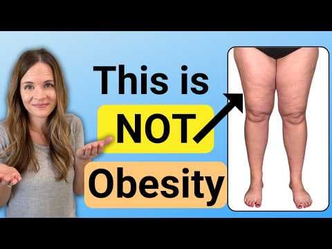 Lipedema. Is it Fat or Swelling? thumbnail
