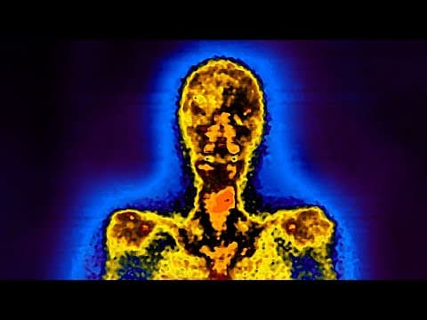 A Man Drank 7 Liters Soda Everyday For 10 Years. This Is What Happened To His Organs. thumbnail