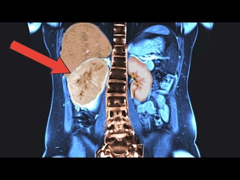 What Rare Cancer Was Found After Persistent Headaches? thumbnail