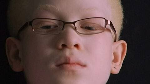 Albinism: Caught Between Dark and Light thumbnail