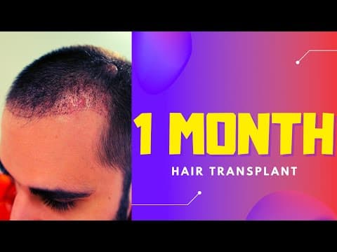 Hair transplant 1 Month Post surgery results  | HELP!!! - THE SHEDDING WONT STOP thumbnail