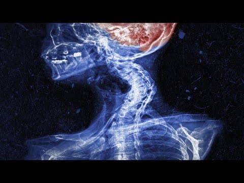 A Mom Did Chiropractic Maneuver On Her Own Neck. This Is What Happened To Her Brain. thumbnail