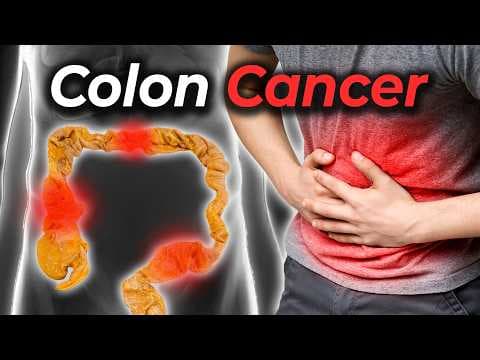 How To Prevent Colon Cancer thumbnail