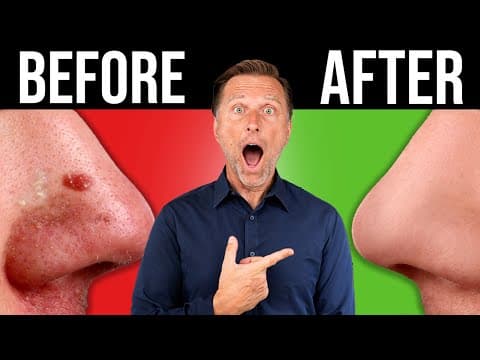 The BEST BLACKHEAD & Acne Remedy in the World (One-Time Fix) thumbnail