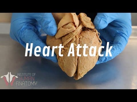 What Happens During a Heart Attack | Anatomy of a Heart Attack thumbnail