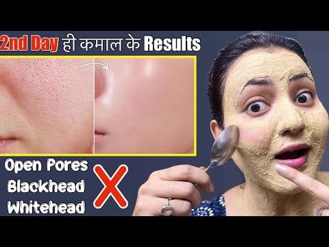 Skin Transformation Challenge (Day 2) : Remove Open Pores Blackhead Whitehead Naturally in 5 Days💕 thumbnail