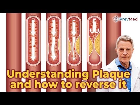 Understanding Plaque and how to reverse it thumbnail