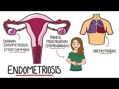 Endometriosis Explained (Signs & Symptoms, Diagnosis, Pathology, Treatment) thumbnail