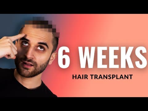 LOCKDOWN UPDATE!!  Fue Hair Transplant 6 Week (1,5 month) post op Istanbul, Turkey! thumbnail
