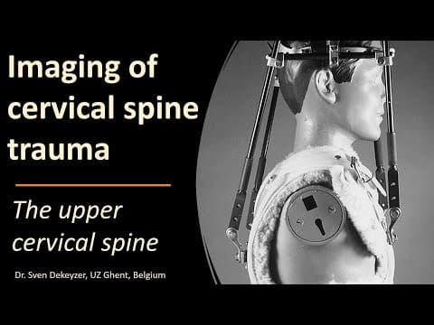 Imaging of Upper Cervical Spine Injuries thumbnail