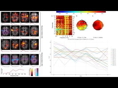 Tinnitus, Brain Networks & Bisensory Neuromodulation Results — Separating Loudness from Distress thumbnail
