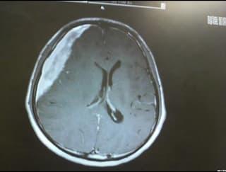 CT scan of my brain at that time. The white part is blood.