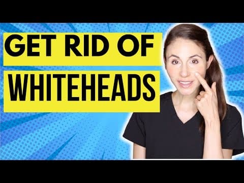 How To Get Rid Of Whiteheads On The Nose thumbnail