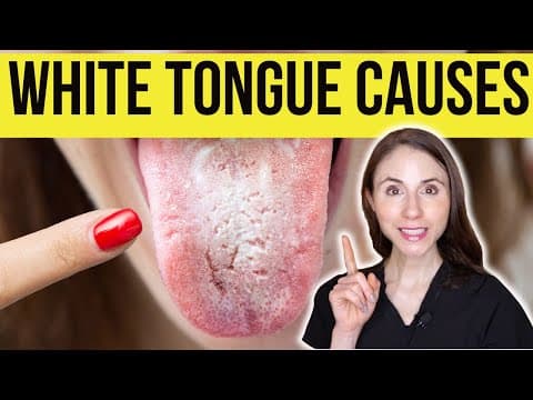 What Causes White Tongue? thumbnail