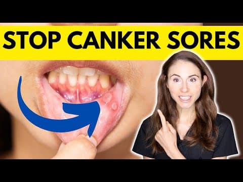 What Are Canker Sores and How Can You Prevent Them? thumbnail