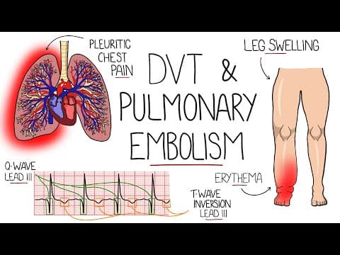 Deep Vein Thrombosis (DVT) & Pulmonary Embolism Explained thumbnail