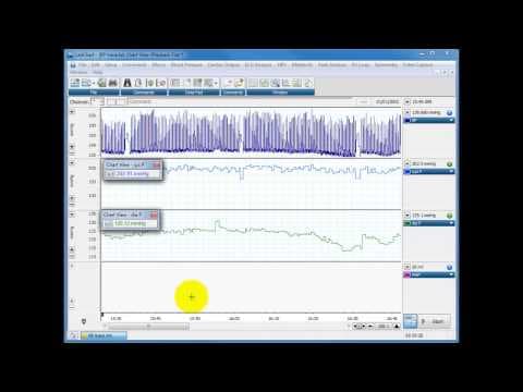 Calculating systolic, diastolic and MAP from blood pressure traces thumbnail