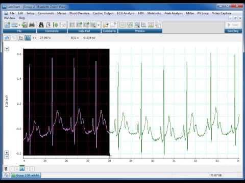 How to Use the Zoom Window in LabChart for ECG Analysis thumbnail