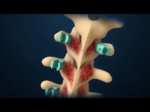 Scoliosis | Scoliosis Surgery | Nucleus Health thumbnail
