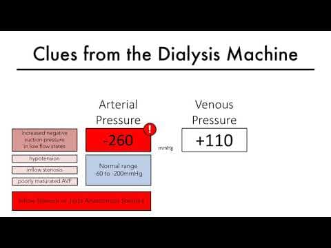 How Can Dialysis Machine Readings Indicate Access Stenosis? thumbnail