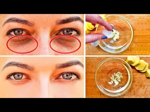 How to Get Rid of Black Circles Under Your Eyes thumbnail