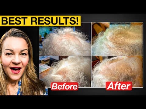 Natural hair loss treatments compared: Red light v Calecim v Growband! thumbnail