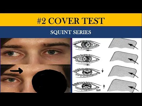 COVER TESTS | Direct Cover , Indirect cover , Cover-Uncover and Alternate cover test thumbnail