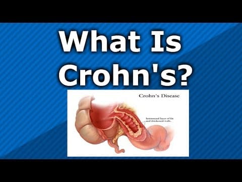 What is Crohn's Disease????? thumbnail