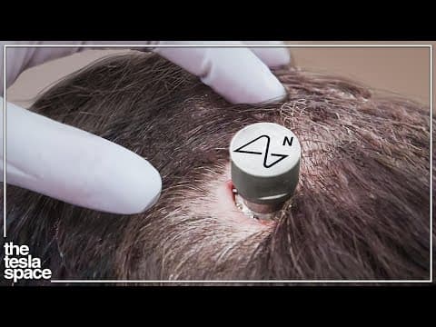 Neuralink Begins Human Trials! thumbnail